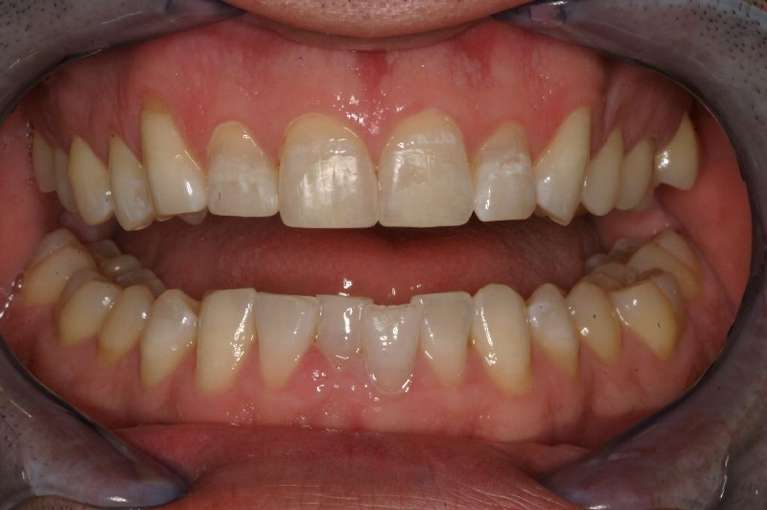 Anterior-Composites-After-Image