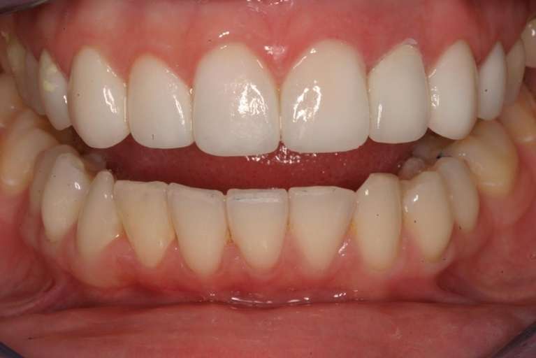 Porcelain-Veneers-After-Image