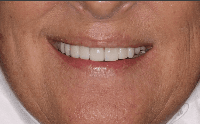 Porcelain-Veneers-After-Image