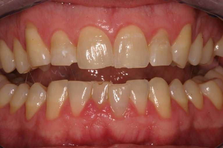 Anterior-Composites-Before-Image