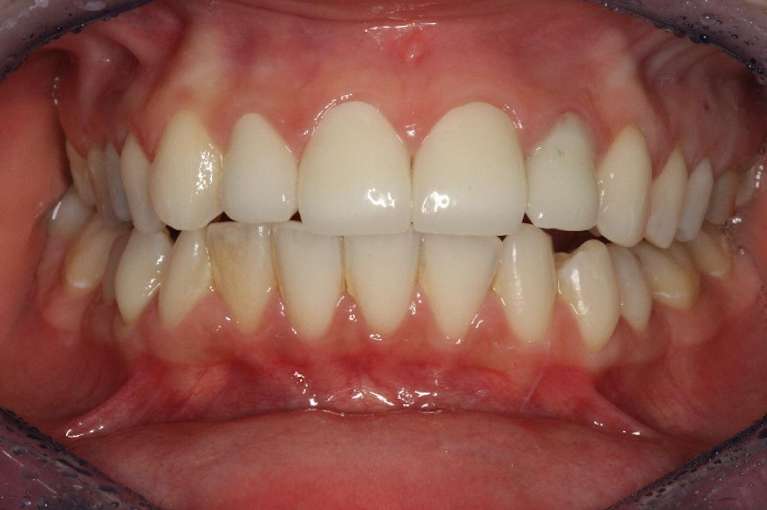 Porcelain-Veneers-Before-Image