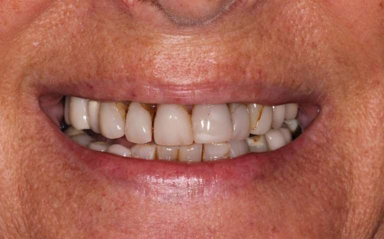 Porcelain-Veneers-Before-Image